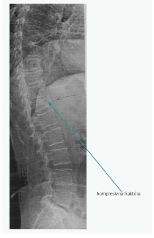 Záchyt kompresívnej fraktúry Th12 pomocou
VFA (presence of vertebral fracture – Th12 on
VFA)