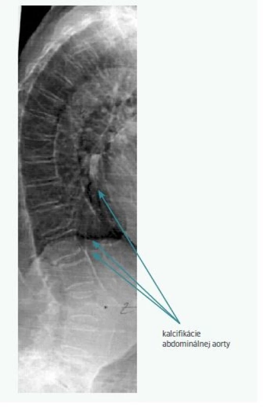 Vizualizácia kalcifikácií abdominálnej aorty
pomocou VFA (abdominal aorta calcifications
on vertebral morphometric scan)