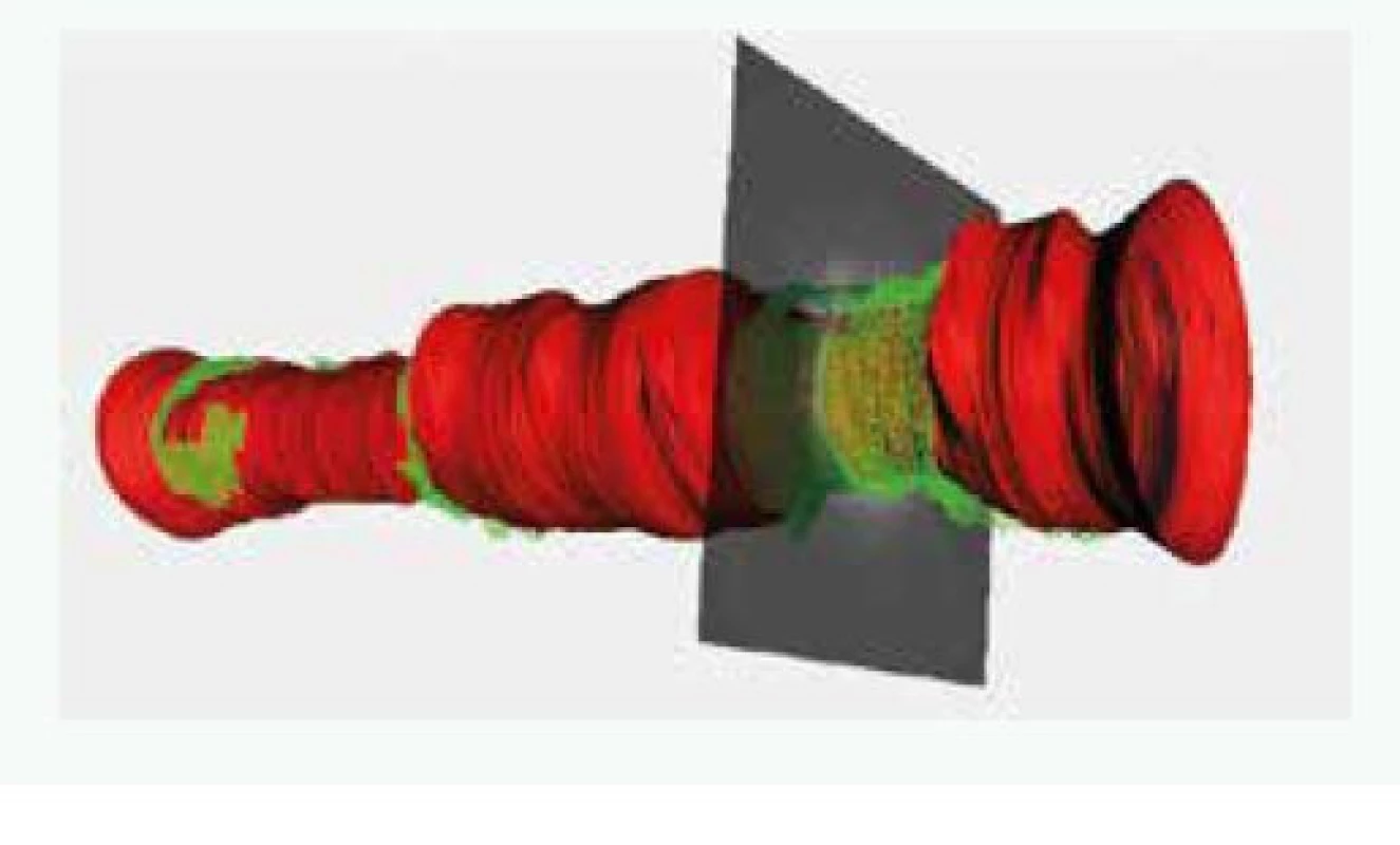 3D-rekonstrukce koronární tepny. Červená
barva představuje tvar a rozměr lumen koronární
tepny: zeleně je označen výskyt segmentů FCT
< 65 μm. Takto lze přesně kvantifikovat plochu
tepny s daným sledovaným parametrem.
Archiv autora